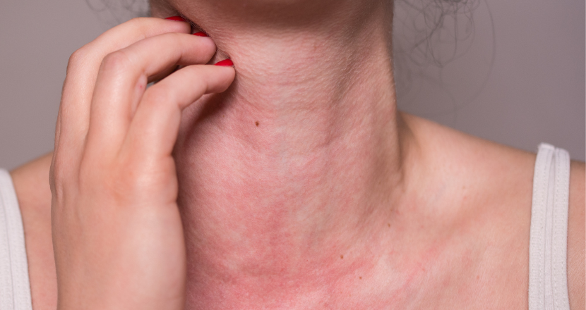mast cell activation syndrome neurological symptoms